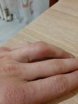 Травма пальца руки фото 2