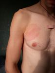 Красное пятно на груди без симптомов фото 1