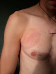 Красное пятно на груди без симптомов фото 2