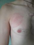 Красное пятно на груди без симптомов фото 4