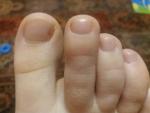 Тёмное пятно под ногтем на большом пальце ноги фото 2