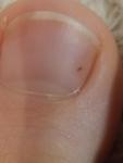 Тёмное пятно под ногтем на большом пальце ноги фото 1