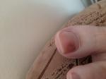 Гематома на ногте коричневого цвета с темными пятнами фото 3