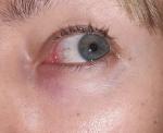 Воспаление глазного мясца фото 1