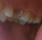 Реставрация зуба фото 1