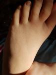 Лопнувшие сосуды на ногах у ребенка фото 5