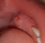 Прорезывание зубов у ребенка фото 1