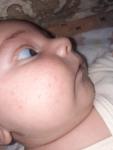 Высыпания на лице у месячного ребенка фото 1