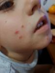 Сыпь у ребёнка 6 лет фото 2