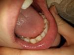 Черные пятна на зубах фото 3