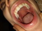 Черные пятна на зубах фото 4