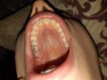 Черные пятна на зубах фото 1