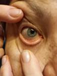 Кератоз глаз фото 1