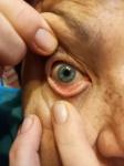 Кератоз глаз фото 3