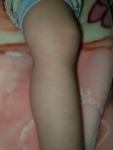 У ребенка на ножках розовые, шершавые пятнышки фото 1
