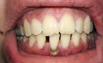 Разрушение зубов, зубные камни фото 1