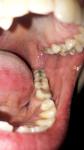 Разрушение зубов, зубные камни фото 2