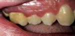 Разрушение зубов, зубные камни фото 3