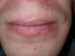 Сыпь вокруг губ фото 3