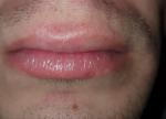 Сыпь вокруг губ фото 2