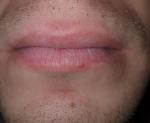 Сыпь вокруг губ фото 1