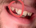 Консультация, повернут зуб по оси фото 2