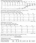 Результат исследования холтера. Стенокардия фото 2