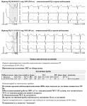 Результат исследования холтера. Стенокардия фото 3
