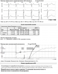 Результат исследования холтера. Стенокардия фото 4