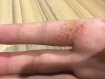 Мелкие, водянистые пузырьки на пальцах рук, после антисептиков фото 1