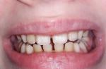 Белые пятна на коренных зубах фото 1