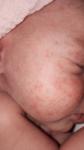 Прыщи у новорожденных в 4 недели фото 1