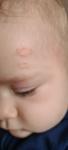 Сыпь у ребёнка, воспаление кожи, лышай фото 2