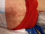 Аллергия на мазь акридерм фото 2