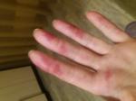 Кровоизлияния на ладонях и пальцах фото 2