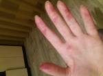 Кровоизлияния на ладонях и пальцах фото 1