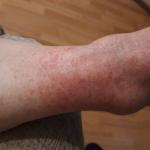 Красное пятно на ноге, аллергия фото 1