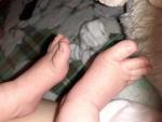 Вросшие ногти у новорожденного фото 3