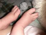 Вросшие ногти у новорожденного фото 2
