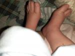 Вросшие ногти у новорожденного фото 1