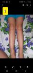 Странные синяки на ногах фото 3
