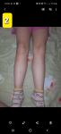 Странные синяки на ногах фото 2