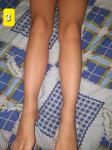 Странные синяки на ногах фото 1
