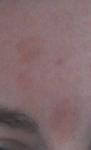Красные пятна на лбу - себорейный дерматит? фото 1