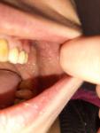 Шишка на щеке во рту со стороны зубов фото 3