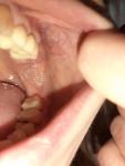 Шишка на щеке во рту со стороны зубов фото 2