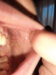Шишка на щеке во рту со стороны зубов фото 1