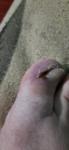 Синий палец, после удаления вросшего ногтя фото 1