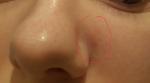 Около носа болезненное уплотнение фото 1