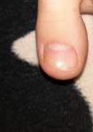 Изменения ногтя у ребенка фото 2